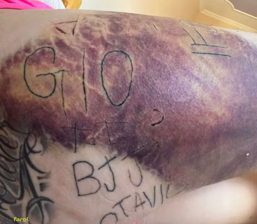 Mulher torturada e tatuada à força pelo ex-companheiro inicia remoção das marcas