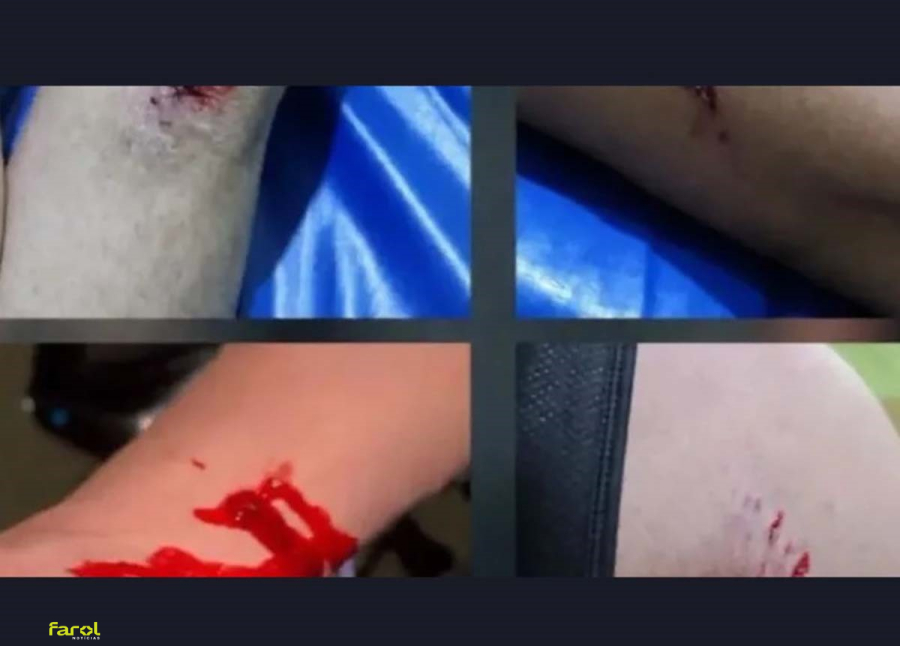 Pai enfrenta pitbull e salva filha de 3 anos durante ataque 